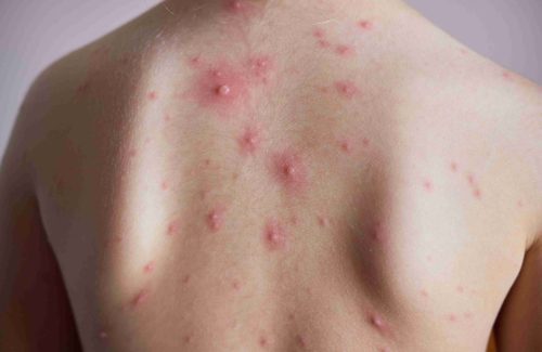 Curse of chicken pox strikes the territory’s Catholic schools