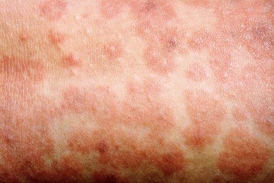 Community health alert as measles case revealed