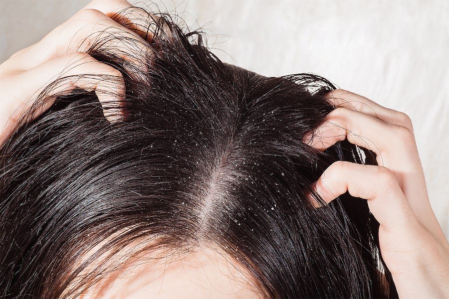 What is dandruff? Why does it keep coming back?